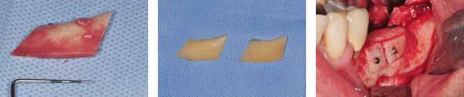3D-Knochenaufbau mit Eigenknochen in unserer Praxis 3D-Knochenaufbau mit Eigenknochen in unserer Praxis