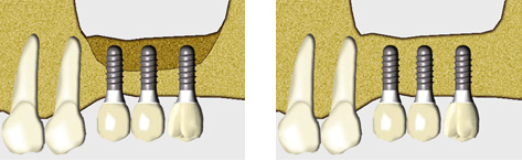 Knochenaufbau im Bereich der Kieferhöhle Knochenaufbau im Bereich der Kieferhöhle