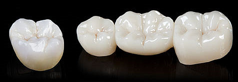 Keramische Kronen und Brücken Keramische Kronen und Brücken